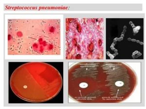 Стрептококк пневмония в зеве