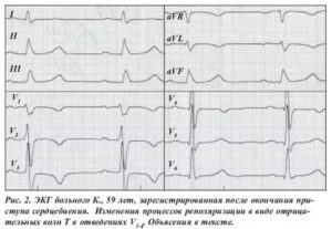 ЭКГ. Нарушение процессов реполяризации в миокарде ЛЖ