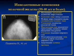 Протокол маммографии: Тени негомогенных лимфатических узлов в зоргиевских зонах