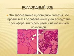 Коллоидный зоб