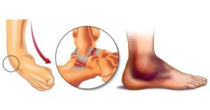 Частичное повреждение капсульно-связочного аппарата голеностопного сустава