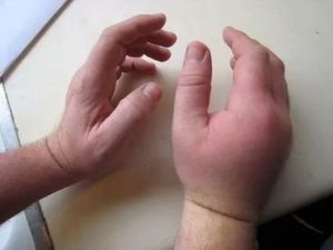 Не сходит отек на суставе пальца после операции