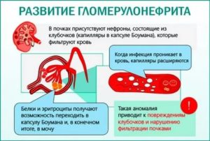 Может ли цистит быть вызван стафилококком