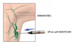 Биопсия лимфоузла