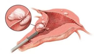 Гистерорезектоскопия полипа эндометрия