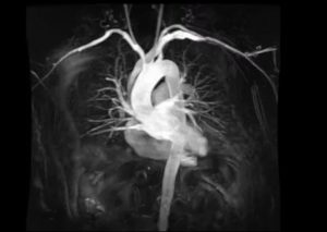 Можно ли делать МРТ при стентах на сосудах сердца