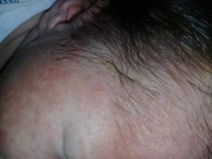 Высыпания на лице после родов
