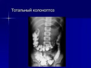 Гастроптоз и колоноптоз