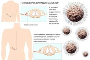 Вирус герпеса и боли в суставах