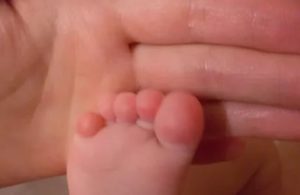 Прыщики на пальцах у младенца