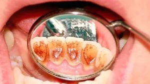 Горечь после лечения зуба