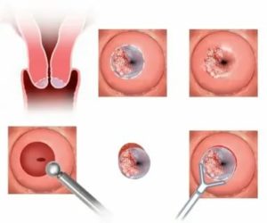 Мягкая шейка матки через неделю после месячных