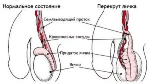 Немеет левое яичко