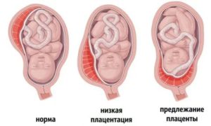 Гипертрофия плаценты