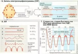 Расшифровать результаты ЭЭГ, РЭГ
