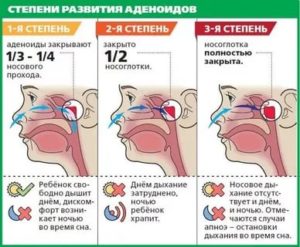 Как вылечить аденоиды 1-2 степени