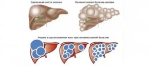 Киста печени у ребенка