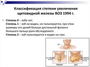 Увеличена левая доля щитовидной железы