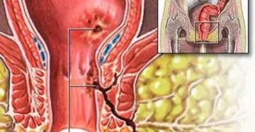 Выделения после парапроктита