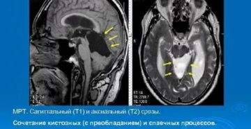 Кистовидное расширение четверохолмной цистерны
