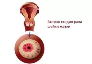 Кератоз шейки матки