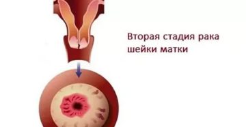 Кератоз шейки матки