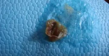 Выделения из носоглотки