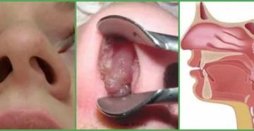 Не проходят сопли после удаления аденоидов Не проходят сопли после удаления аденоидов