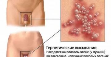 Похоже на герпес на лобке