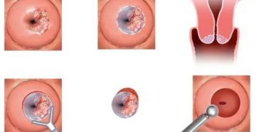 Половой покой после прижигания эрозии