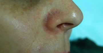 Воспалилось крыло носа