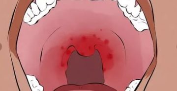 Сухость в горле и покраснение задней стенки глотки