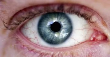 Красные сосуды в белке глаза Красные сосуды в белке глаза