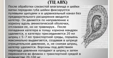 Замершая беременность, нарушение развития ворсин хориона
