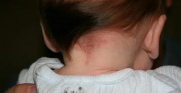 Пятно у грудничка на шее Пятно у грудничка на шее