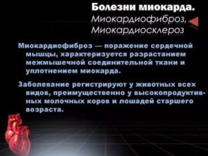 Миокардиофиброз