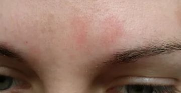 Пятна на лице и под бровями, шелушение