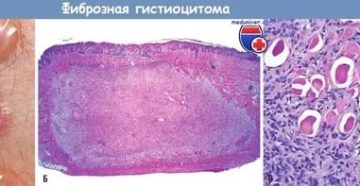 Фиброма. Расшифровка гистологии