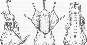 Фимоз операция