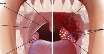 Больно глотать и не понятные шишки в горле Больно глотать и не понятные шишки в горле
