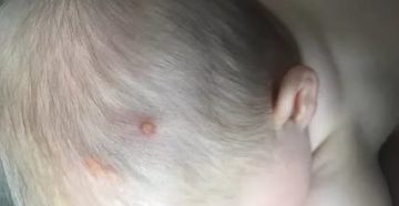 Стрептодермия на голове