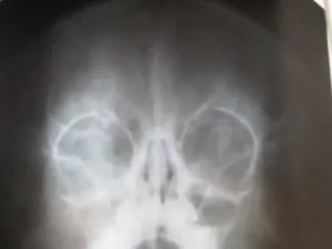 Гайморит на рентгене у ребенка 6 лет