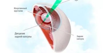 После дисцизии