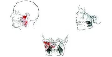Болит угол нижней челюсти