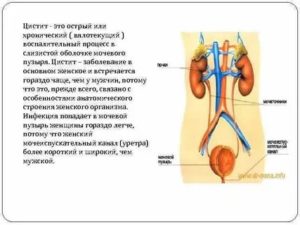 Вялотекущий цистит