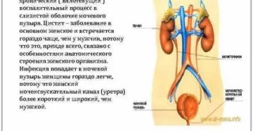 Вялотекущий цистит