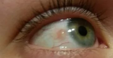 Киста конъюнктивы