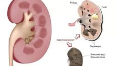 Воспаление почек при орви?