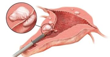 Боли после удаление полипа
