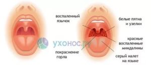 Горло не болит, но есть температура